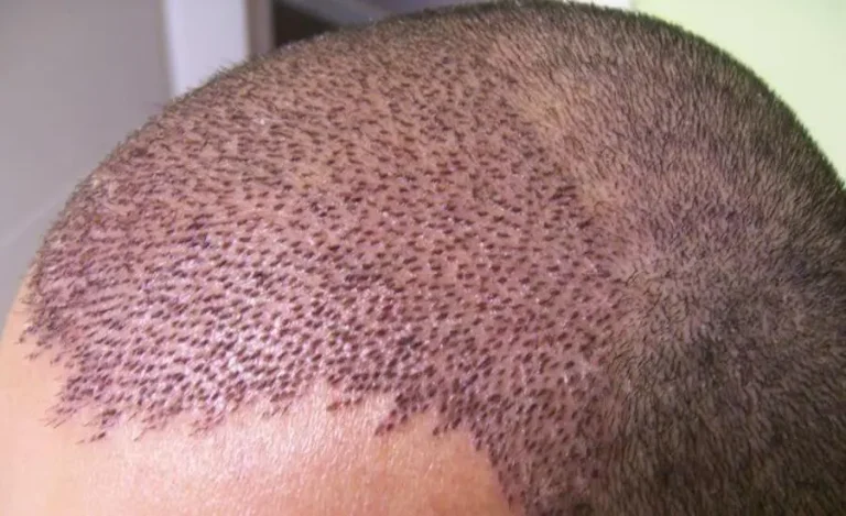 Hair Transplants in Turkey Affordable Solutions for Restoring Your Hairline