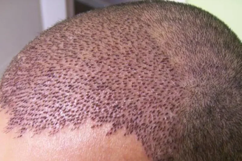 Hair Transplants in Turkey: Affordable Solutions for Restoring Your Hairline